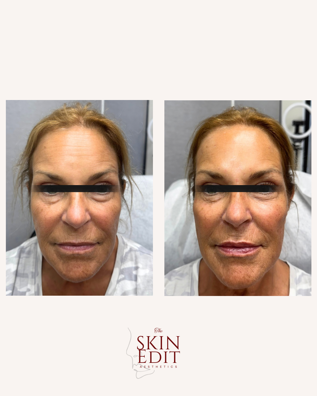 The Skin Edit Aesthetics | Before + After (5).PNG