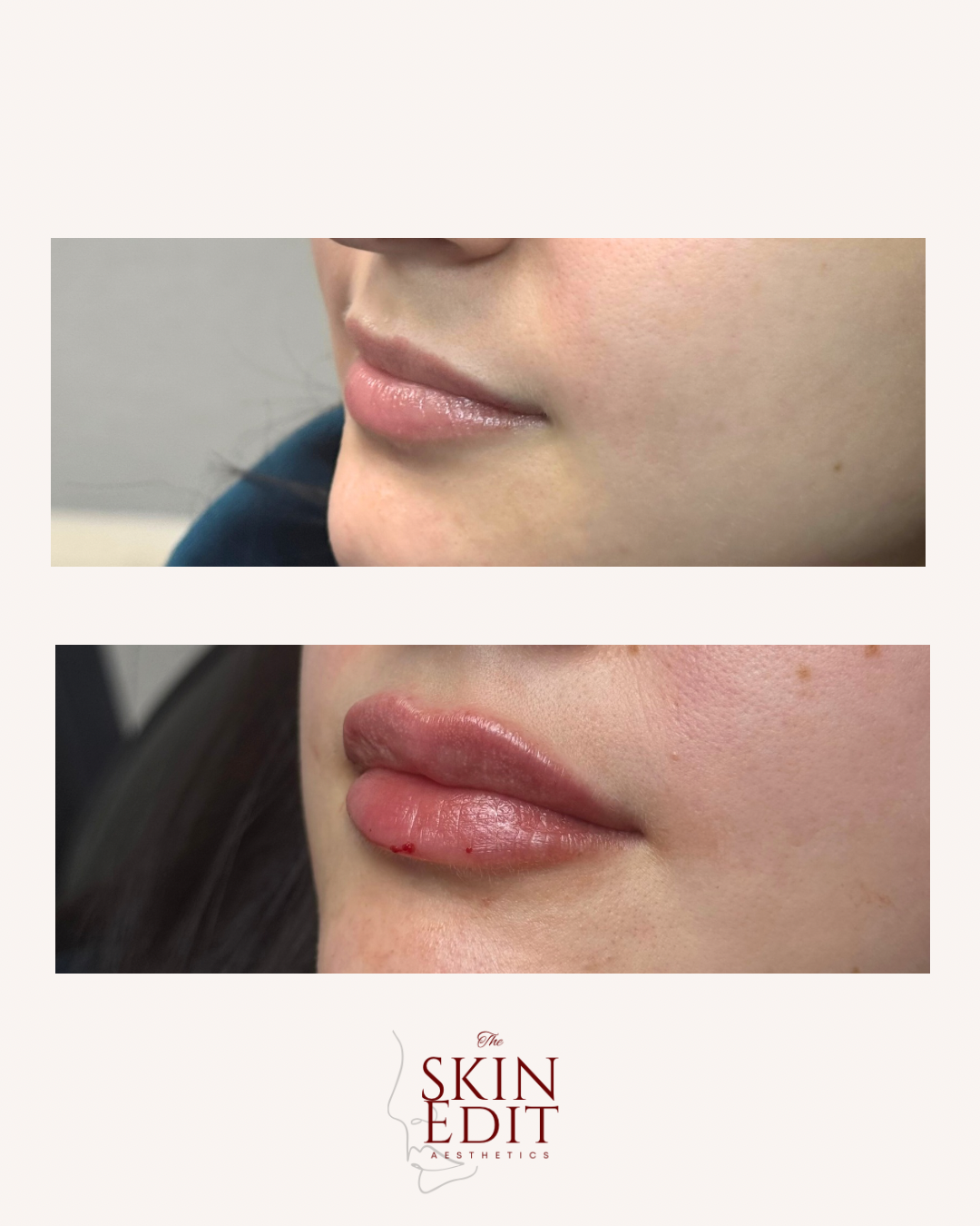 The Skin Edit Aesthetics | Before + After (8).PNG