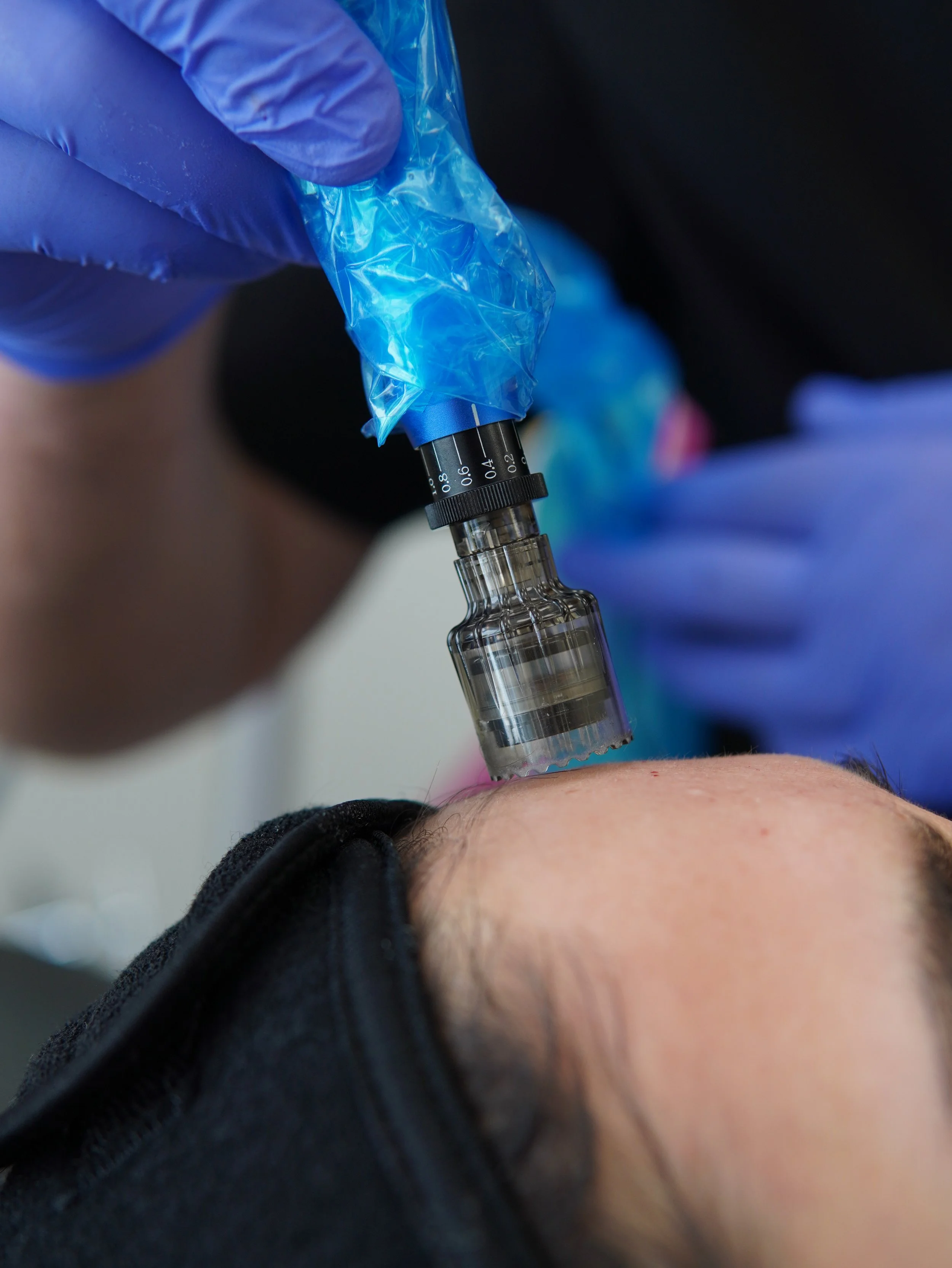 Microneedling in Nashua NH: How It Improves Texture, Scars, and Fine Lines