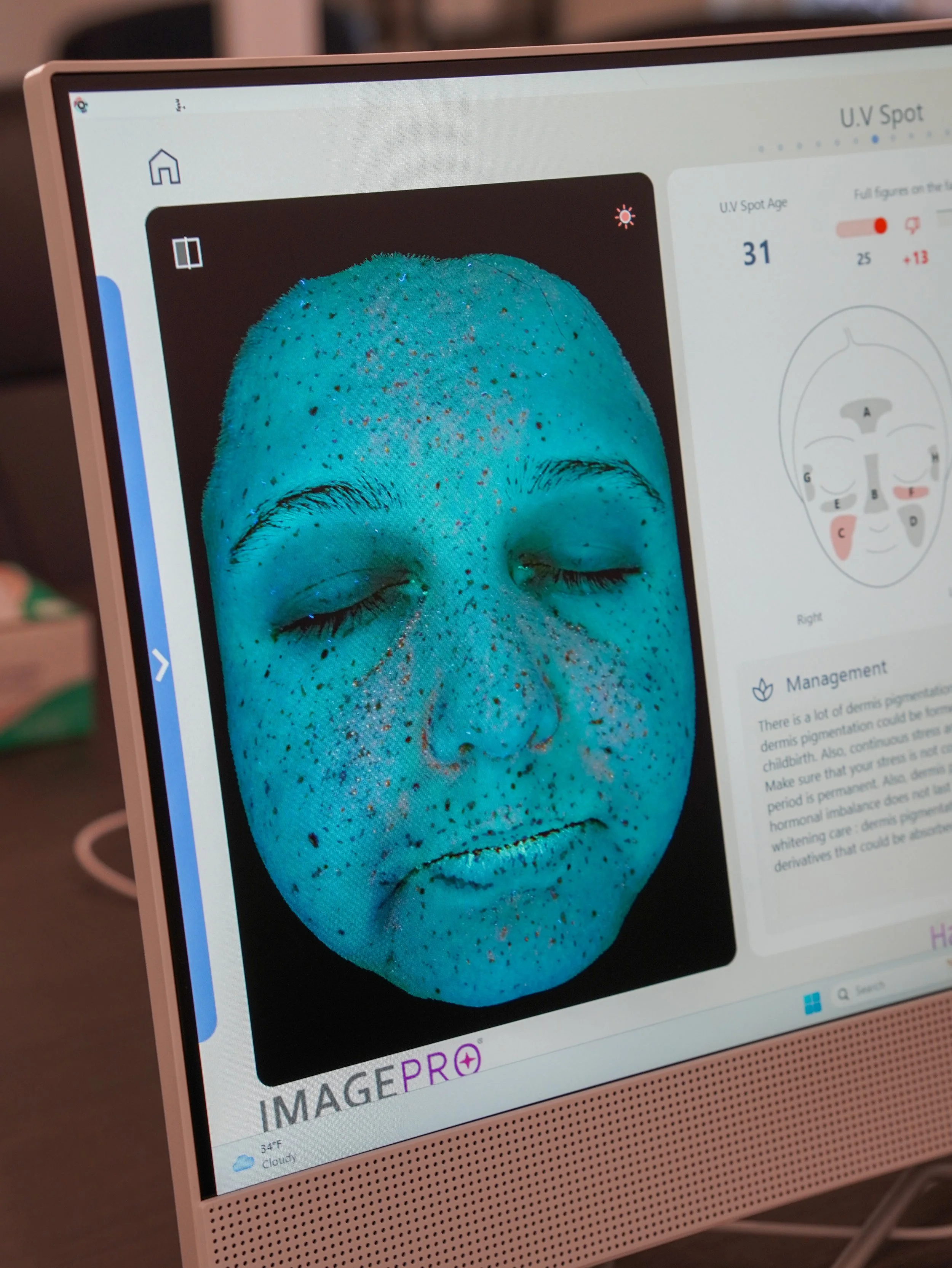 patients UV spot imaging to show their sun damage