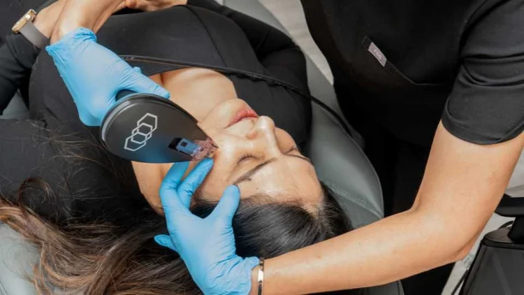 A Morpheus8 skin treatment at Sansa