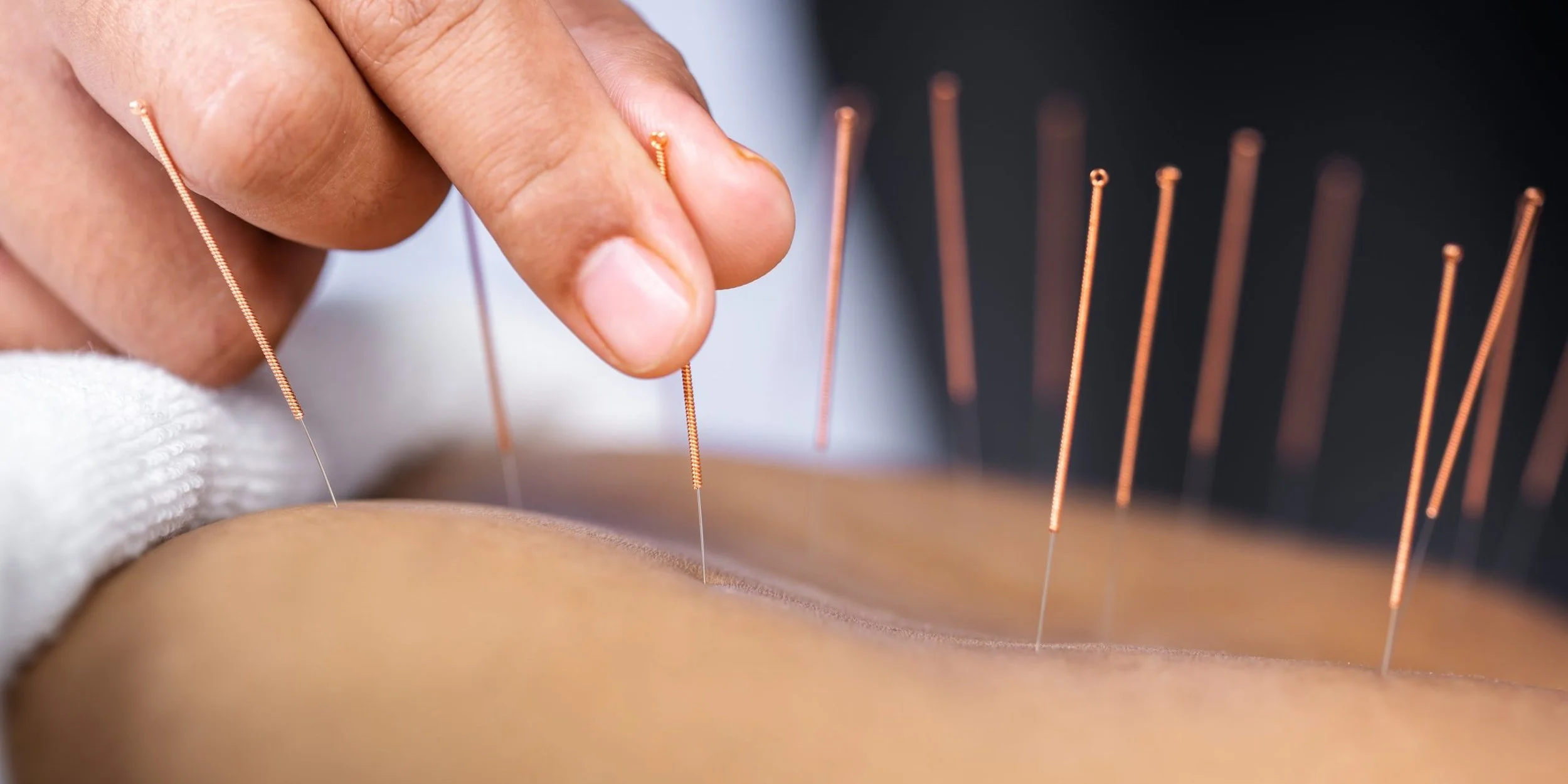 Acupuncture