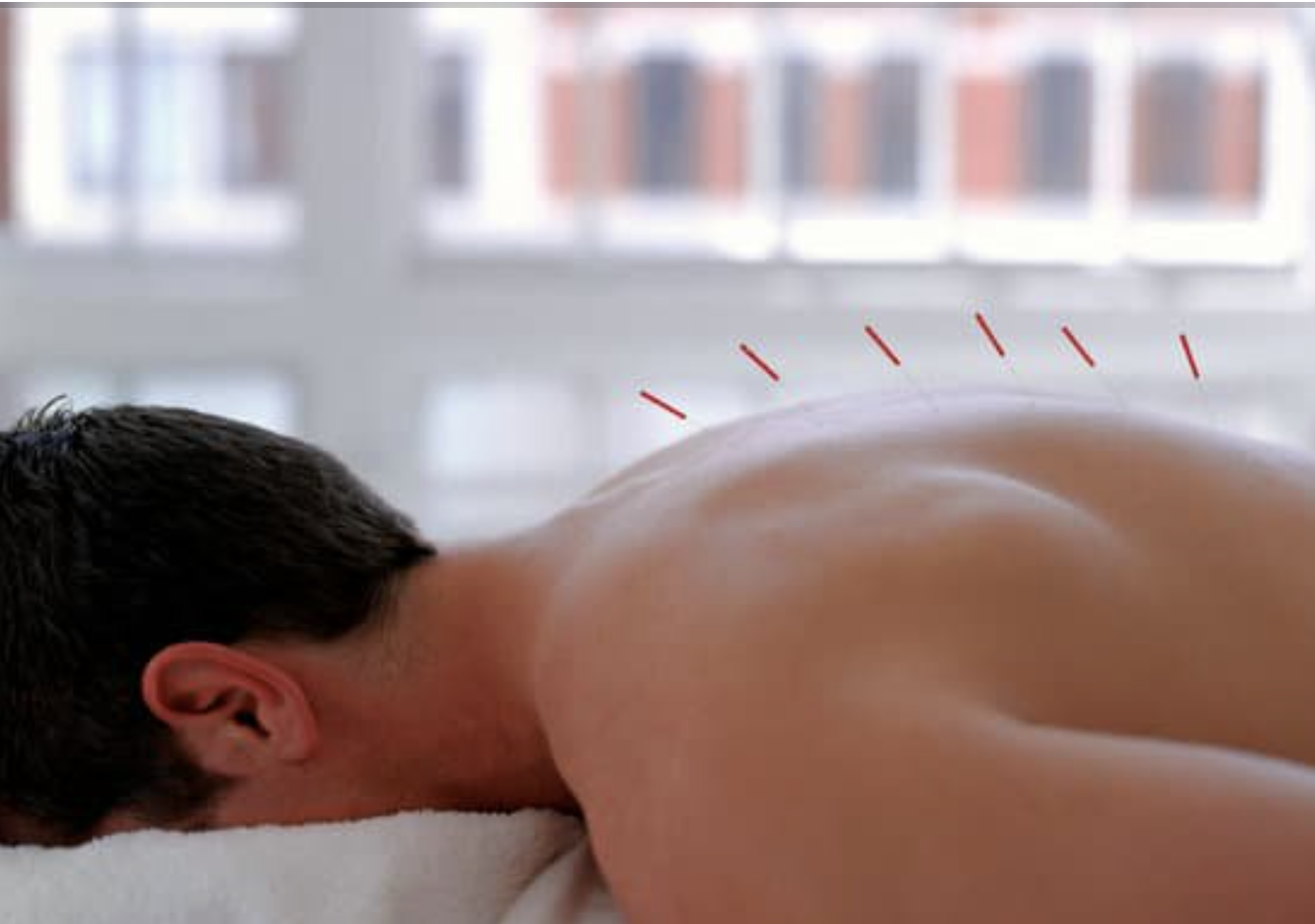 Why Green Berets are Using Acupuncture to Repair Gun Shot Wound Damage and Restore Circulation