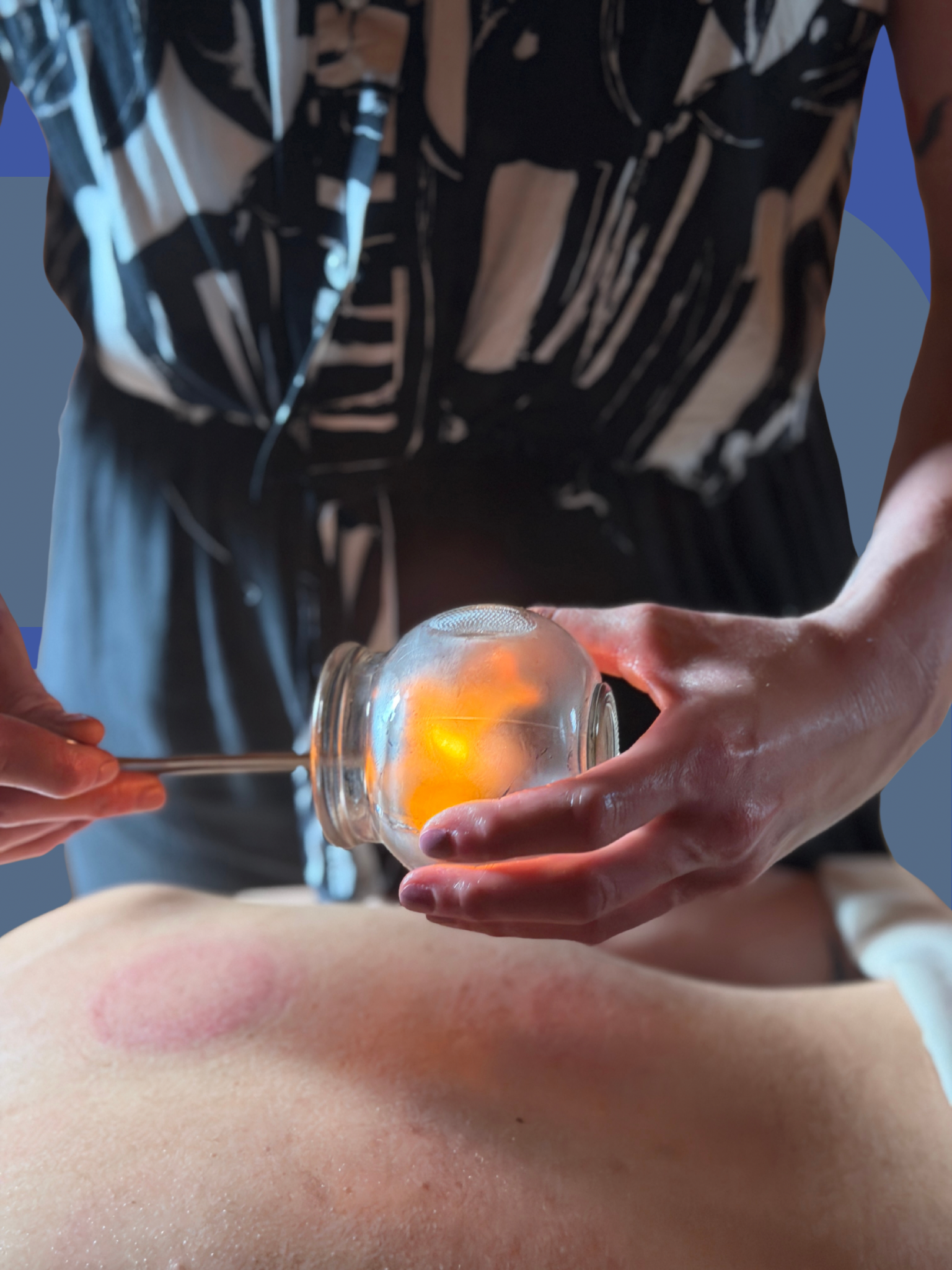 Fire cupping, glass cups, cupping, back pain, shoulder pain, painful muscles, musculoskeletal painful conditions
