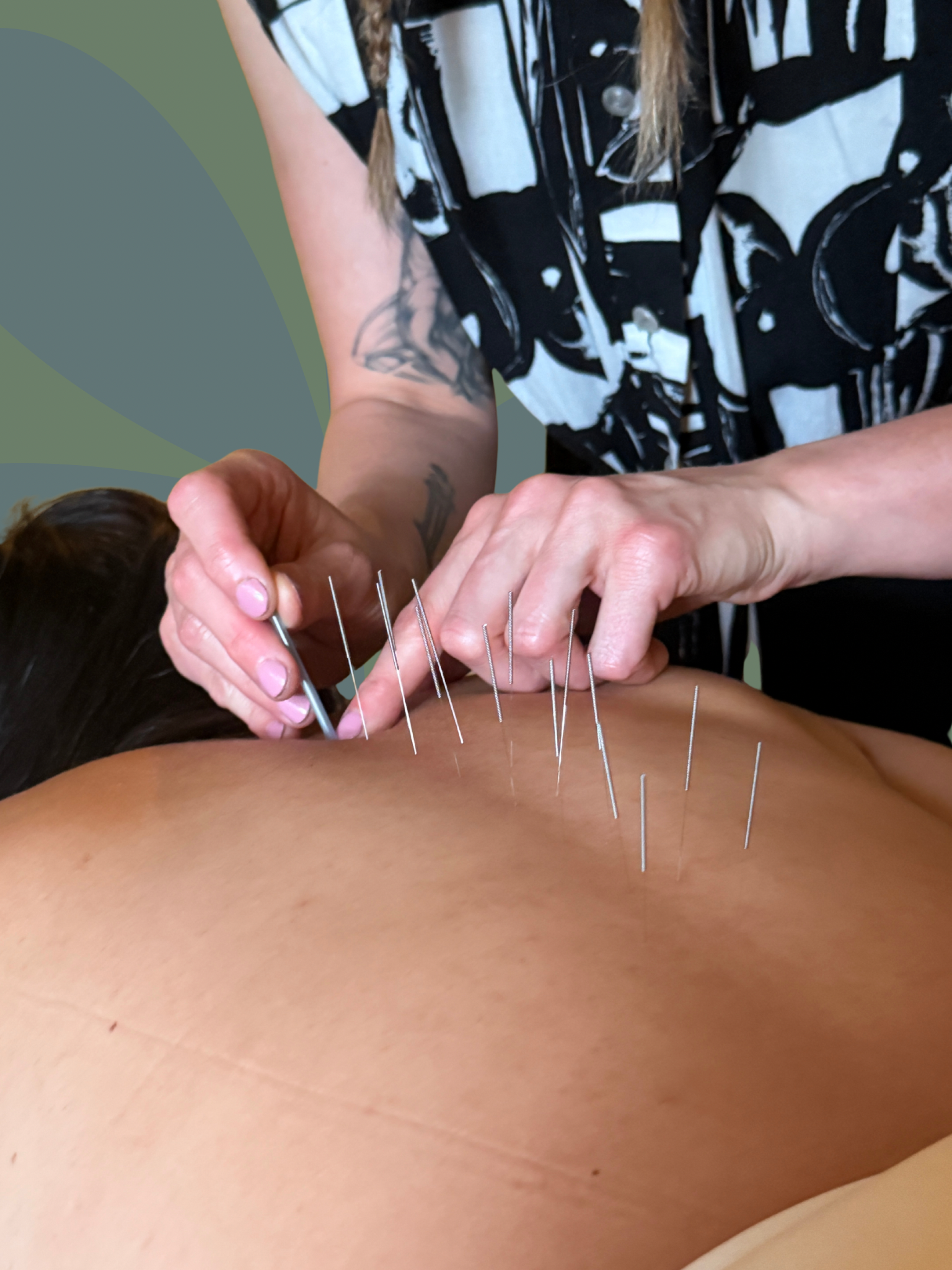 A person receiving acupuncture therapy on their back with several acupuncture needles inserted, while a practitioner holds a needle.