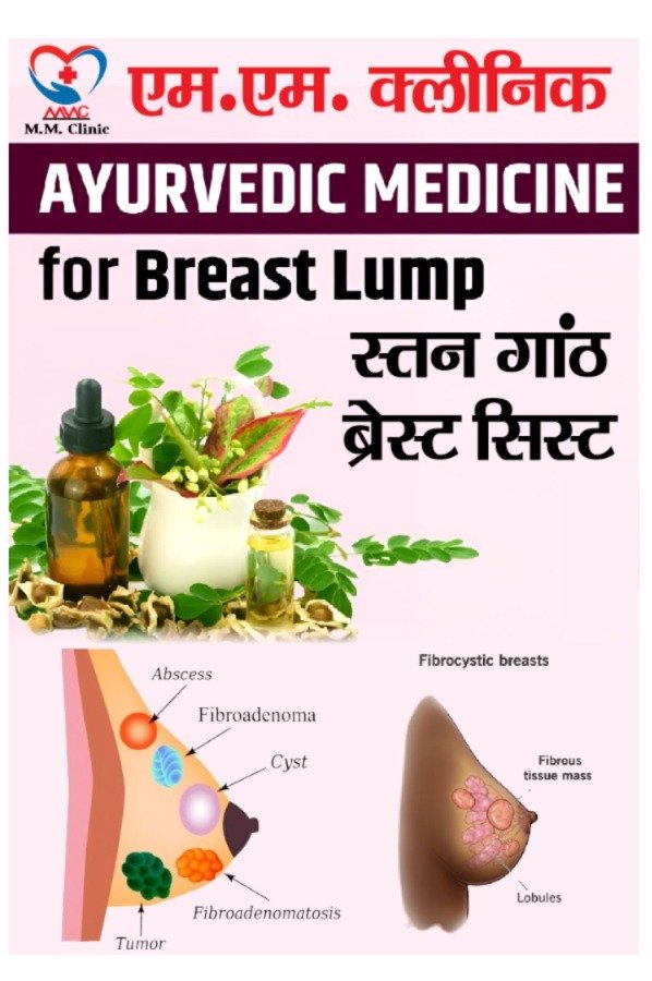 Poster advertising Ayurvedic medicine for breast lumps, featuring herbal remedies, a diagram of breast cysts and fibrocystic breasts, and the clinic's logo
