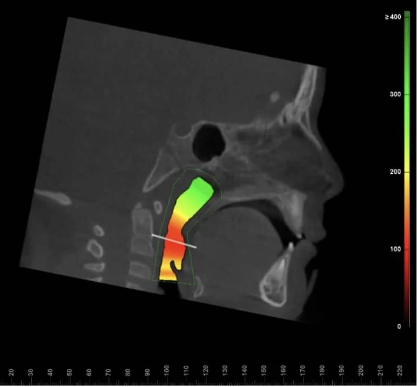 Side view CT scan of head and neck with colored airflow analysis through the upper airway, ranging from green to red.