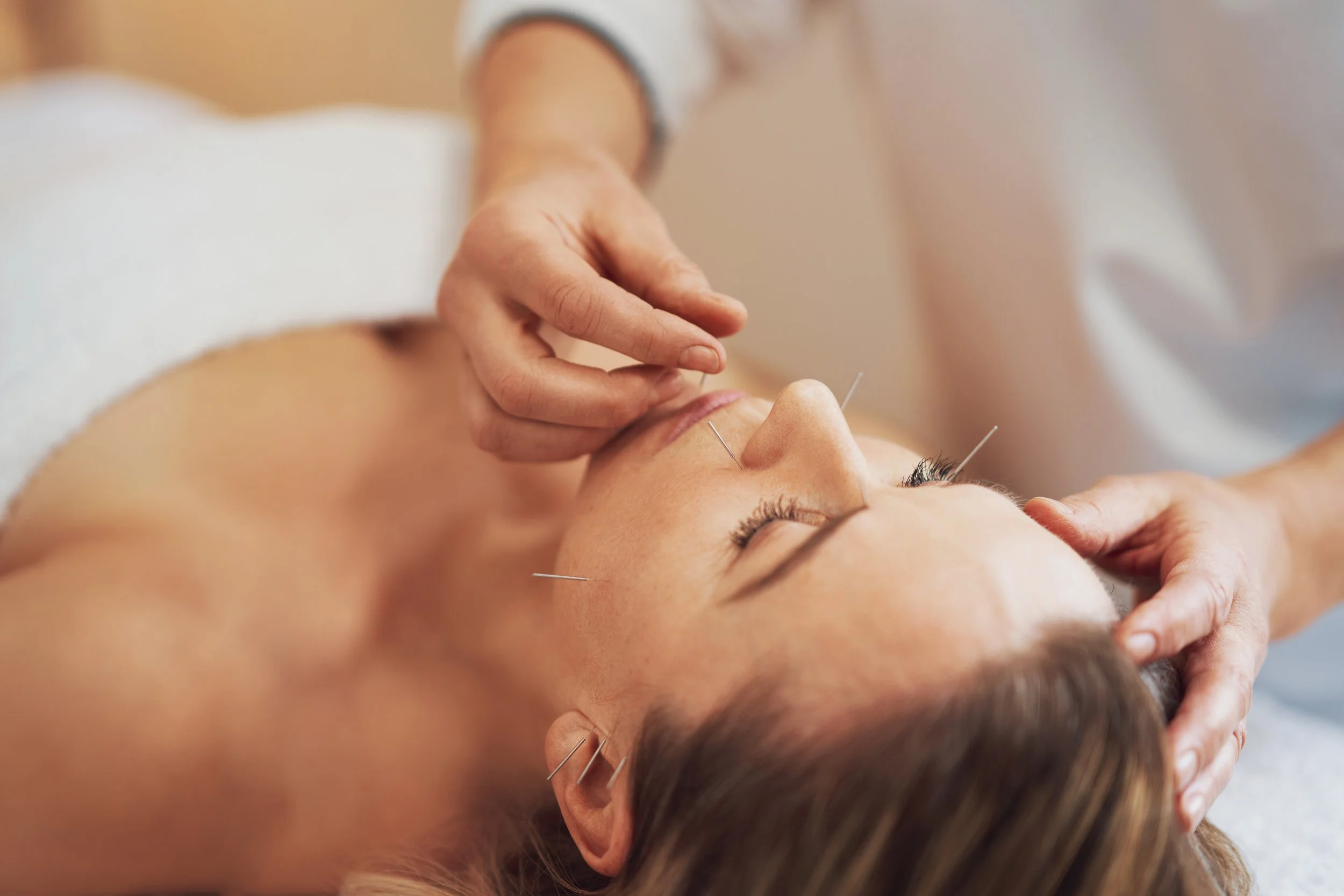 acupuncture-needles-treatment-face