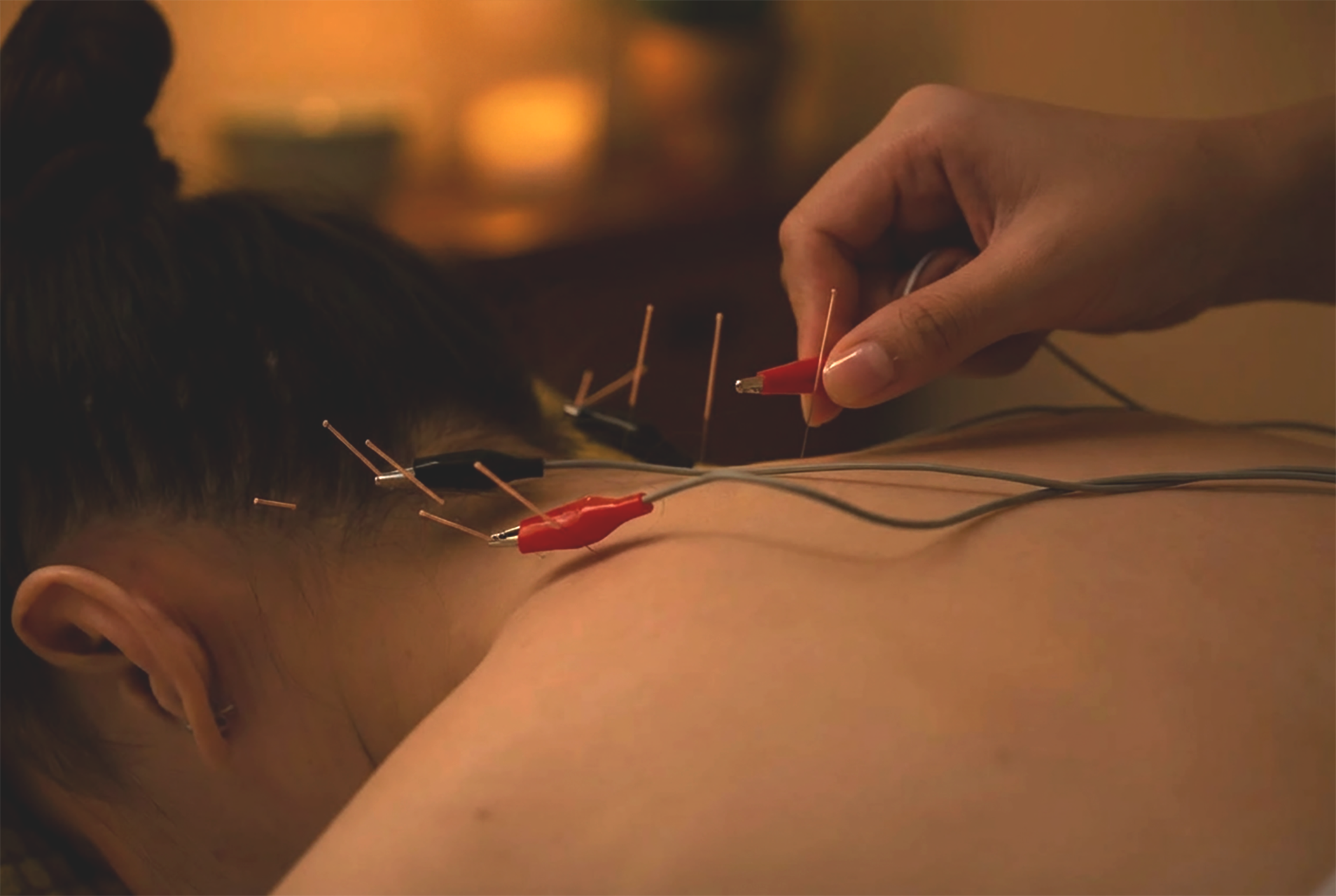 ren-acupuncture-treatment-electric-stimulation