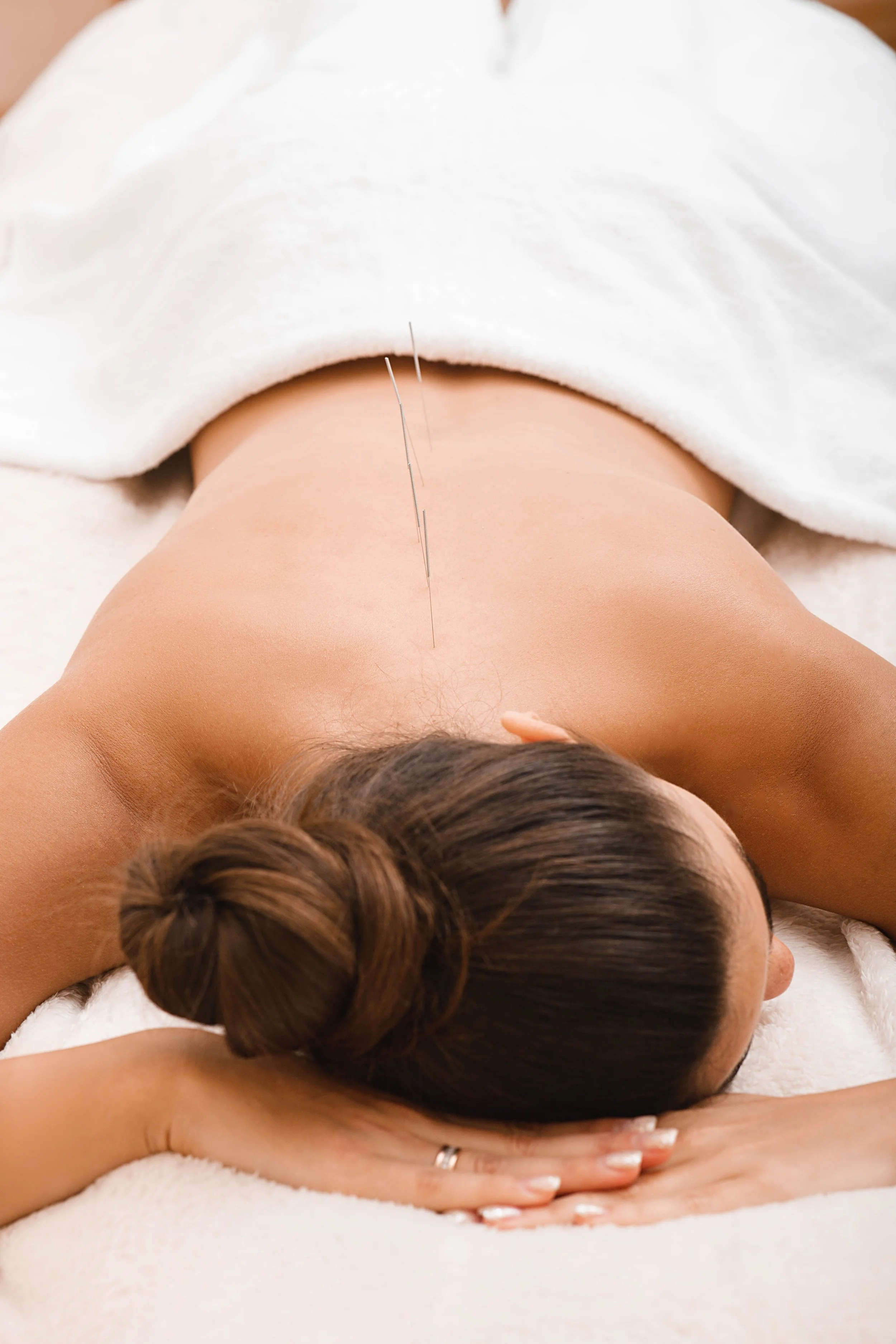 ren-acupuncture-needling-treatment-back
