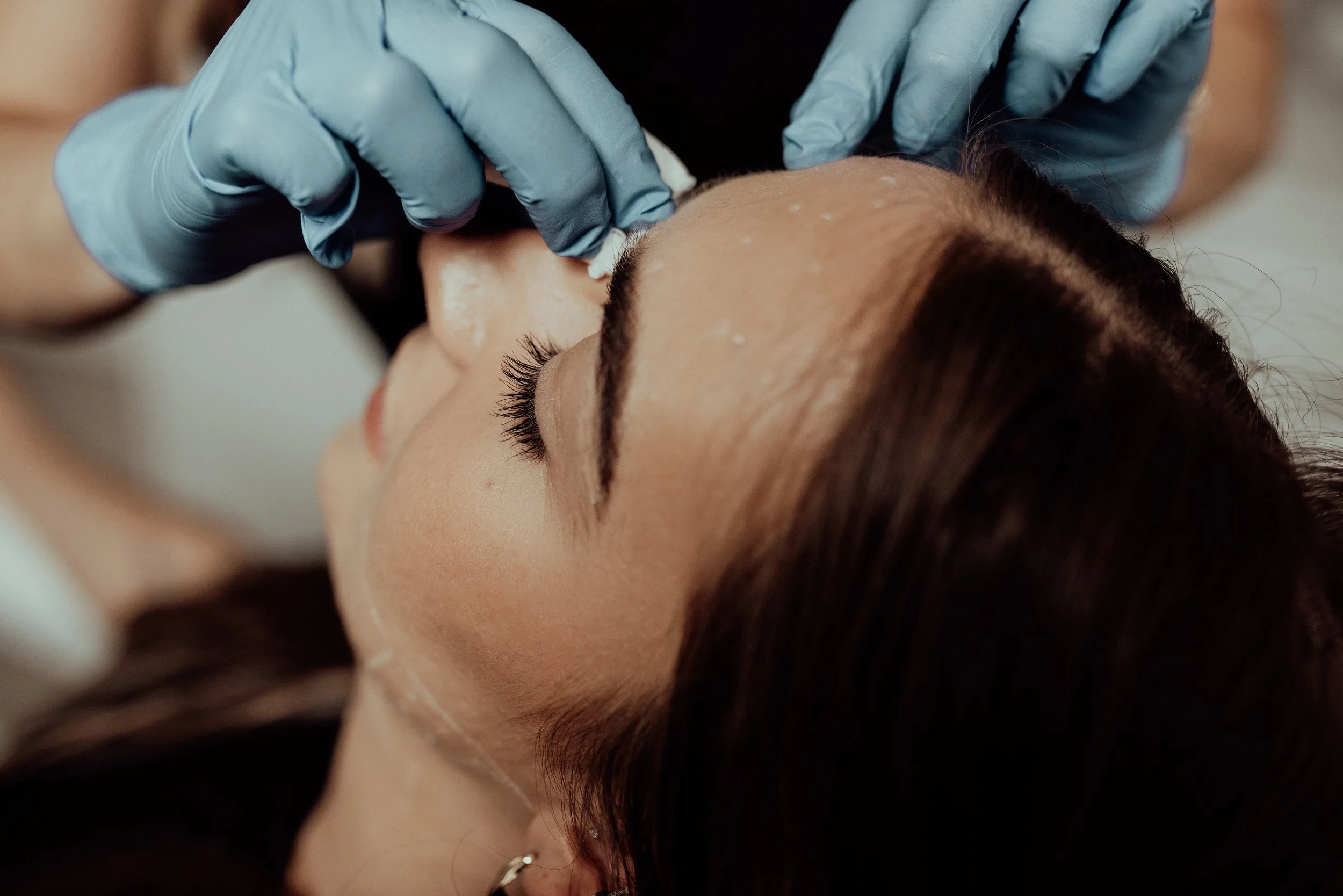 PDO thread lift treatment for facial tightening and contouring at Juvenescence Wellness on Vancouver Island.
