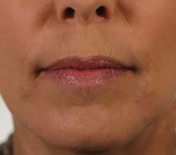 Close-up of a person's mouth and lower face with neutral expression.