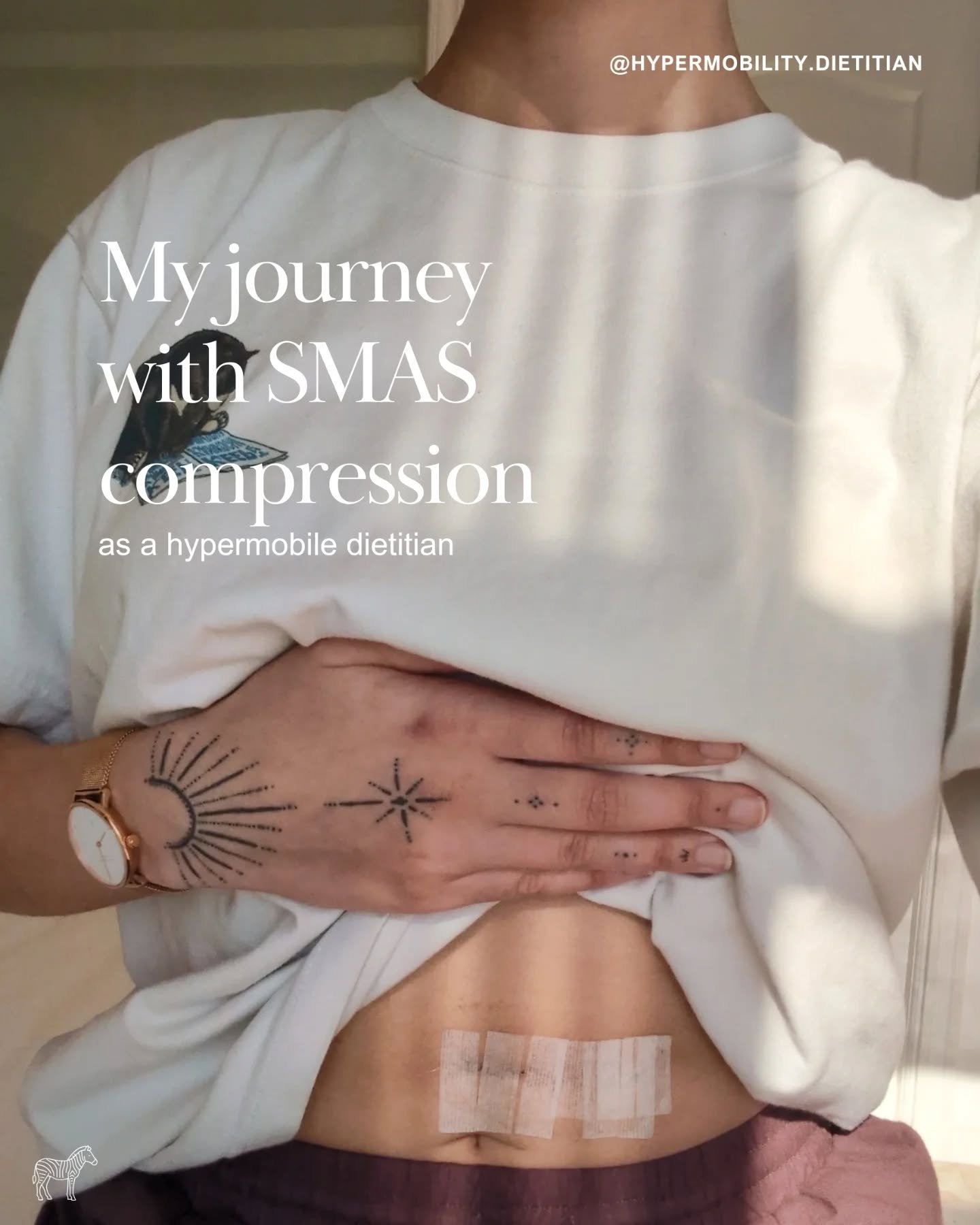 Here's a bit about my journey navigating SMAS compression, including diagnosis, surgery and recovery.

I've been fairly MIA on here over the past year because so much of my energy has gone into being a patient and focusing on my health. I'm incredibl