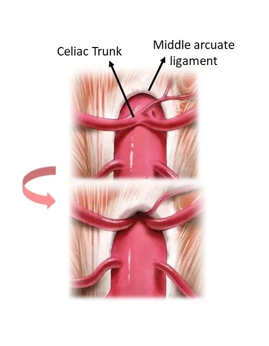 Median Arcuate Ligament Syndrome (MALS): A Hypermobile Dietitian's ...