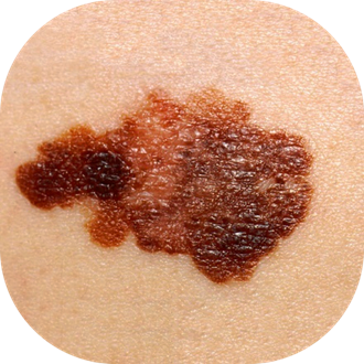 Close-up of a mole or skin lesion on human skin.