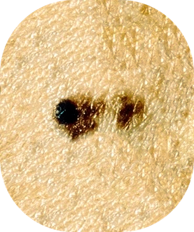 Close-up of a skin mole with three dark spots.