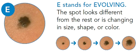Close-up of a skin mole or pigmented spot undergoing a visual change, with a series of smaller images showing the mole's changing appearance over time.