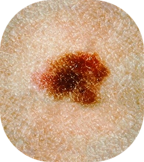 Close-up of a mole on skin with some irregular dark pigmentation.