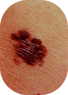 Close-up of a mole with irregular borders and uneven coloration on skin.