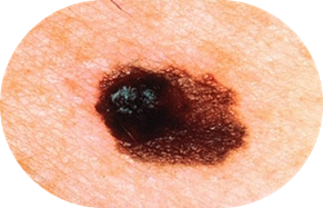Close-up of a mole on skin with irregular borders and dark pigmentation.