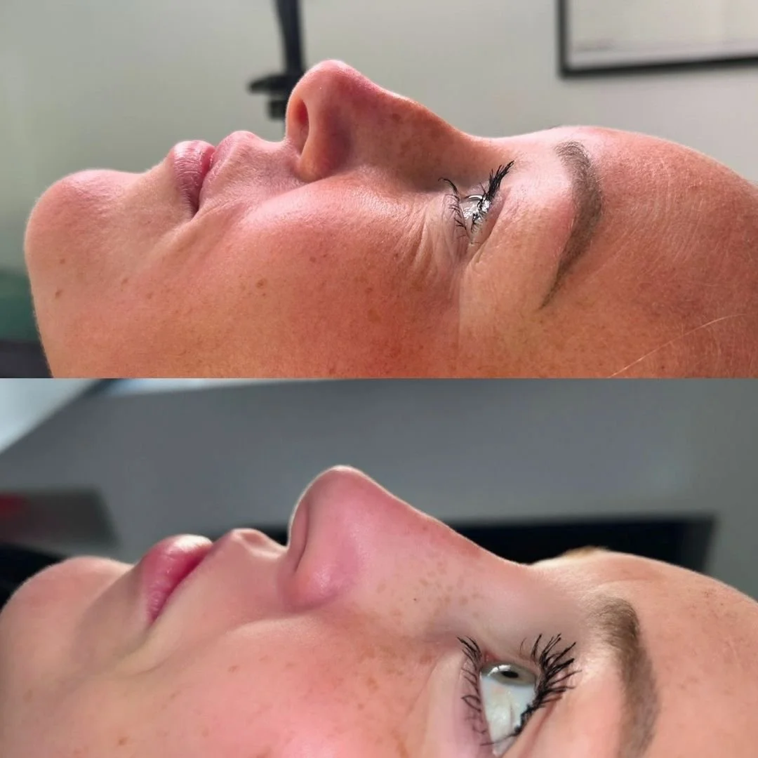 Side-by-side comparison of a woman's face before and after a cosmetic or skincare treatment, showcasing improved skin texture and appearance.