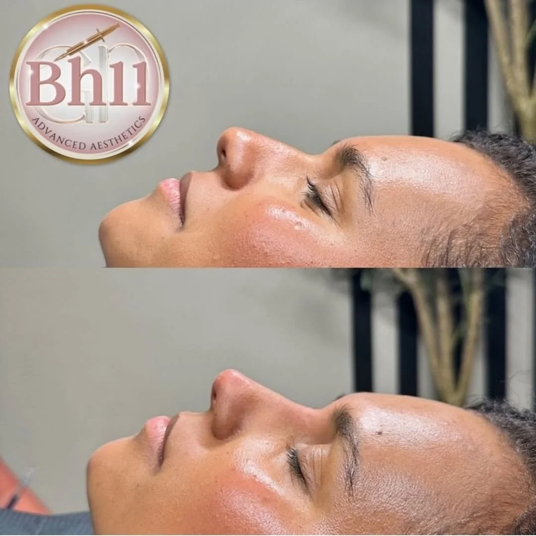 Close-up side profile of a woman lying down with her eyes closed, showing her face before and after a cosmetic treatment, with a logo for BHI Advanced Aesthetics in the top left corner.