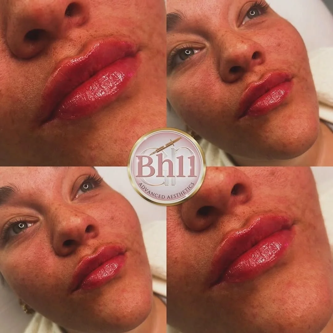 Close-up of a woman with red lipstick and freckles before and after cosmetic lip enhancement at Bh11 Advanced Aesthetics.