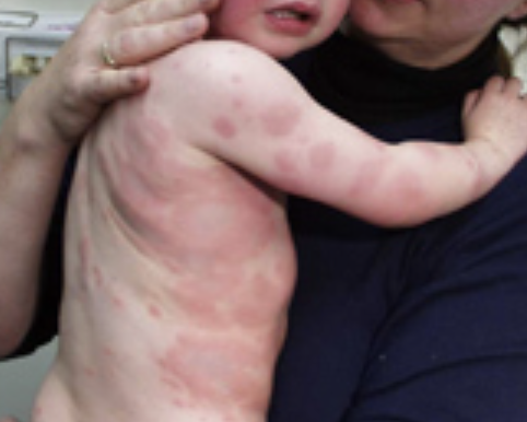 Hives (urticaria) (Mild–Moderate)
Raised, red or pale itchy welts on the skin that can appear suddenly and may move around the body.