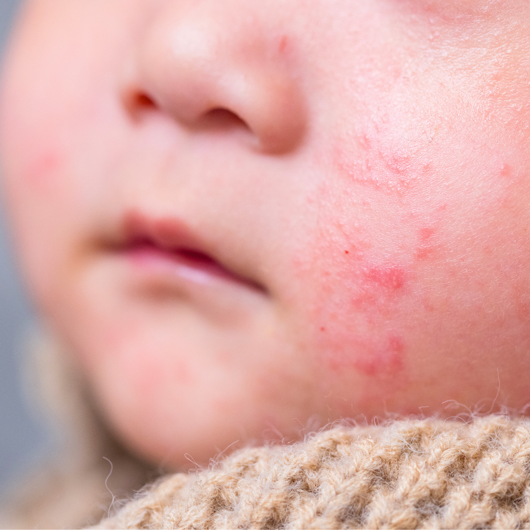 Hives (or urticaria) are raised red bumps or welts on the surface of the skin. Hives can vary in size from small dots to large patches, and often appear in groups across various parts of the body.