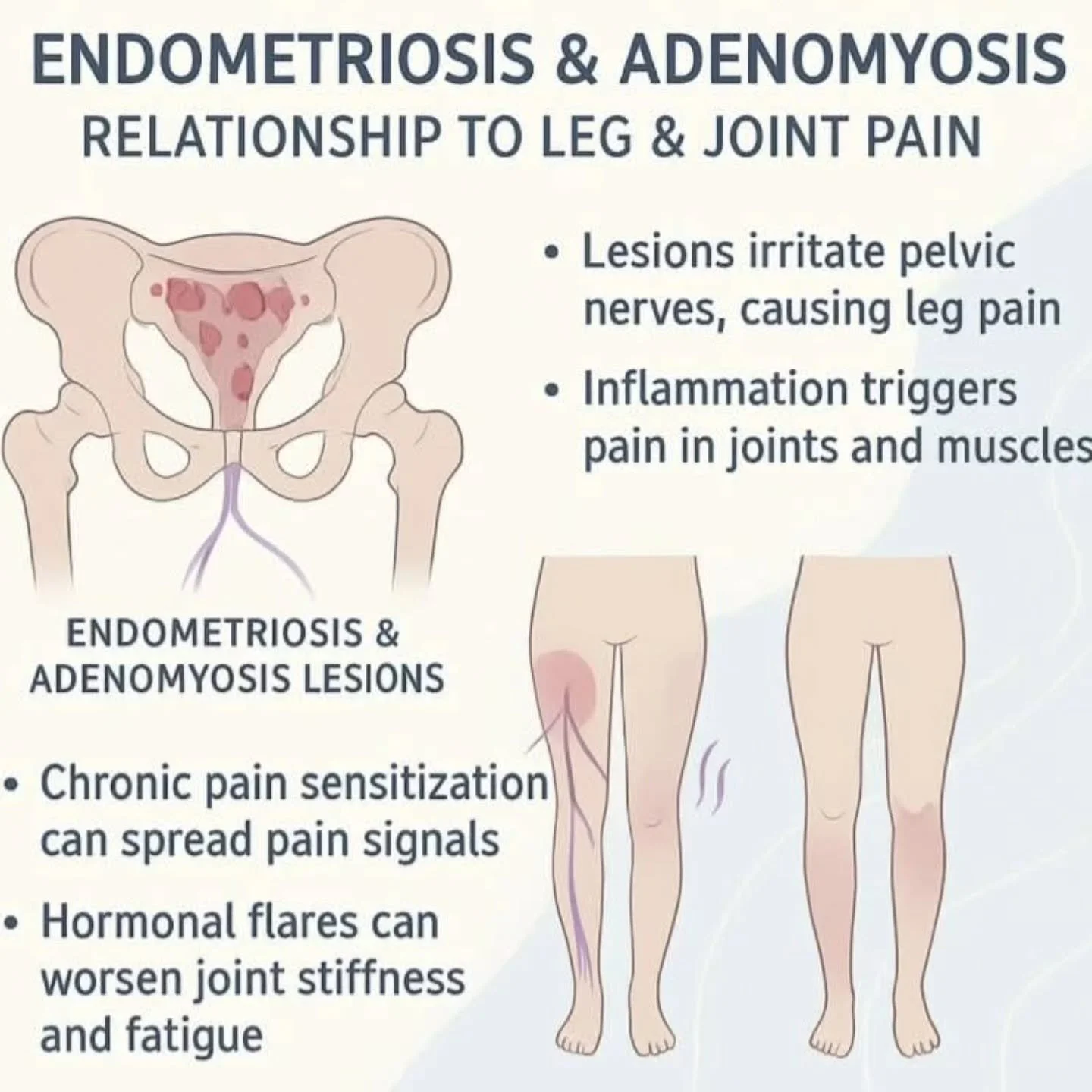 💛 Did you know endometriosis and adenomyosis can trigger leg and joint pain?
The inflammation and hormonal changes can irritate nerves, spread pain signals, and cause stiffness or fatigue.

If you&rsquo;ve been feeling unexplained aches &mdash; it&r