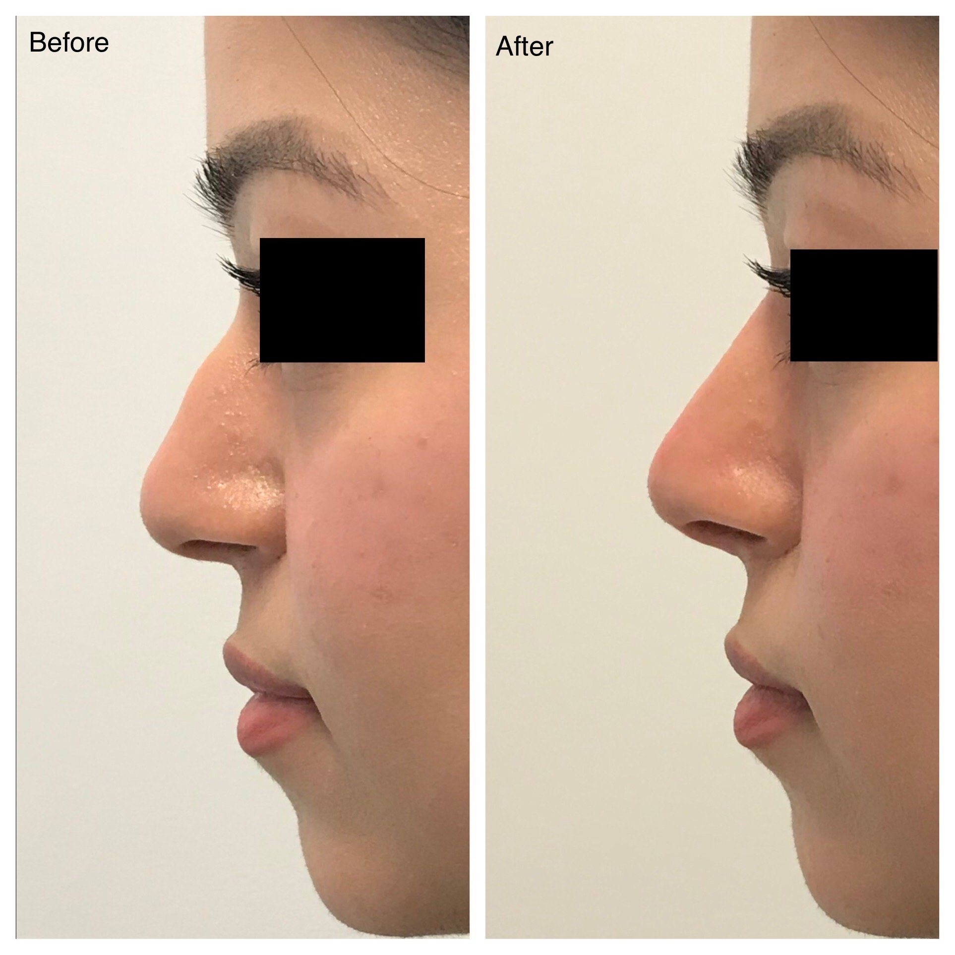 Side-by-side comparison of a person's nose before and after rhinoplasty surgery, showing a more refined nasal bridge in the after image.