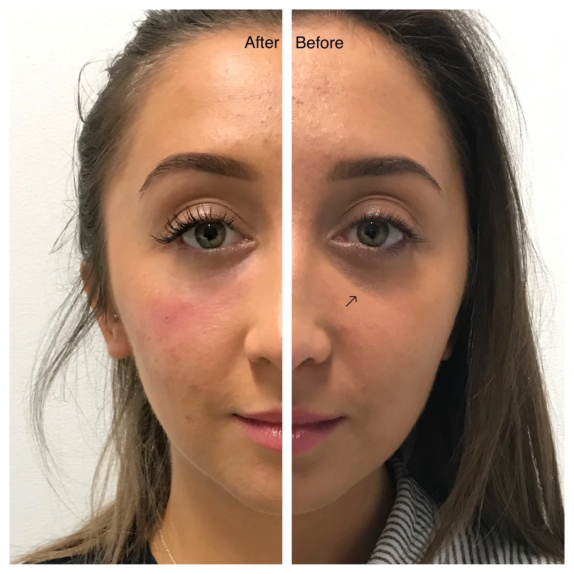 Side-by-side comparison of a woman's face showing her before and after a skincare treatment. The left side is labeled 'After' with smooth skin and visible makeup, while the right side is labeled 'Before' with visible skin imperfections and no makeup.