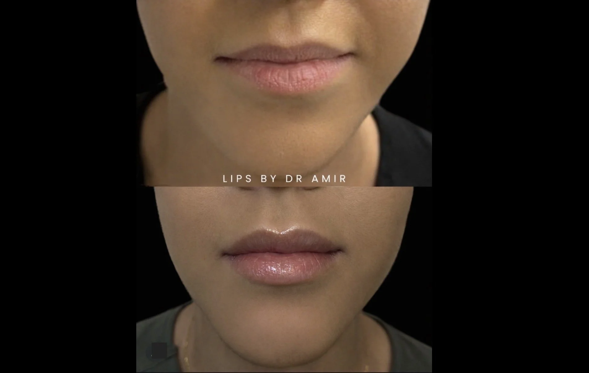 Lip Filler