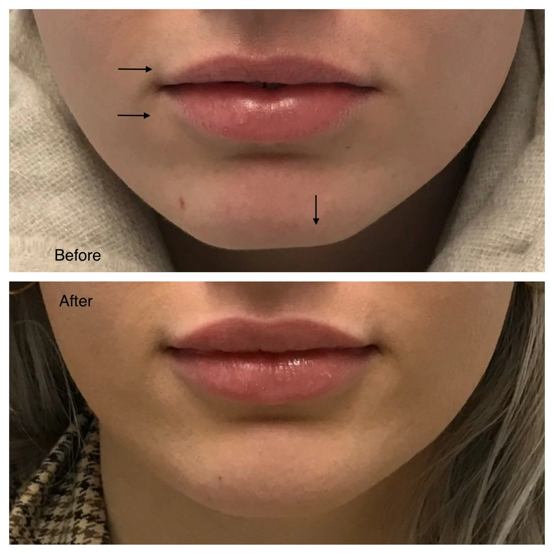 Comparison of lips before and after cosmetic enhancement, showing fuller, more defined lips in the after image.