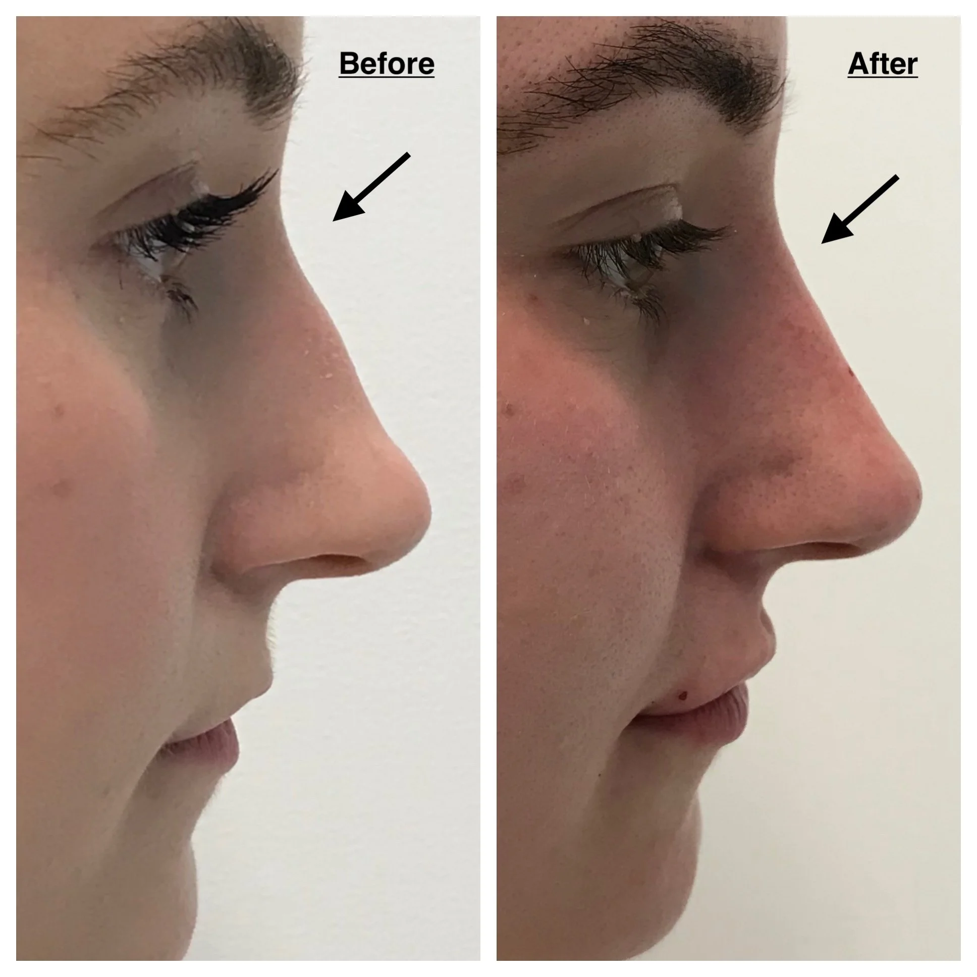 Side-by-side comparison of a person's nose before and after rhinoplasty, showing slight change in nose shape and contour.