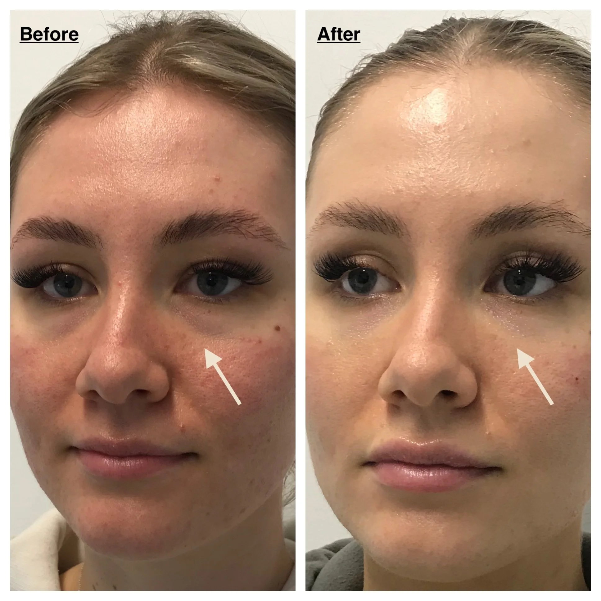 Side-by-side comparison of a woman's face before and after skincare treatment, showing improved skin texture and reduced redness, with arrows pointing to the cheek area.