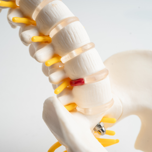Medical model of the human spine showing vertebrae, a red herniated disc, and spinal screws and rods used in spine surgery.