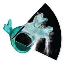 Close-up view of a human eye with a contact lens partially inserted, with eye examination equipment in the background.