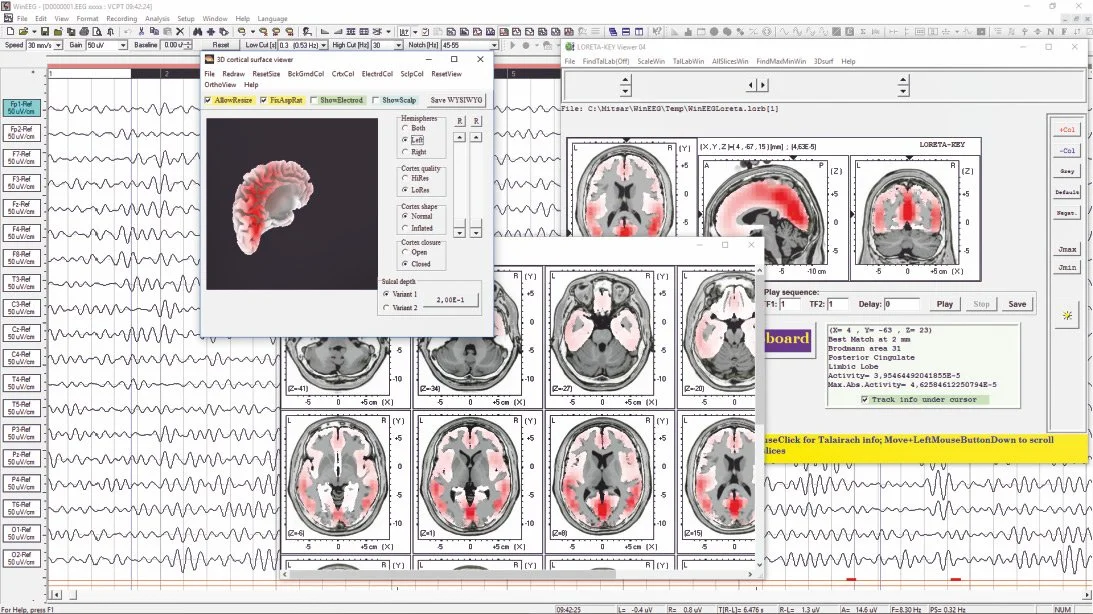 Computer screens displaying brain scan images, electroencephalogram data, and software interfaces related to neurological analysis.