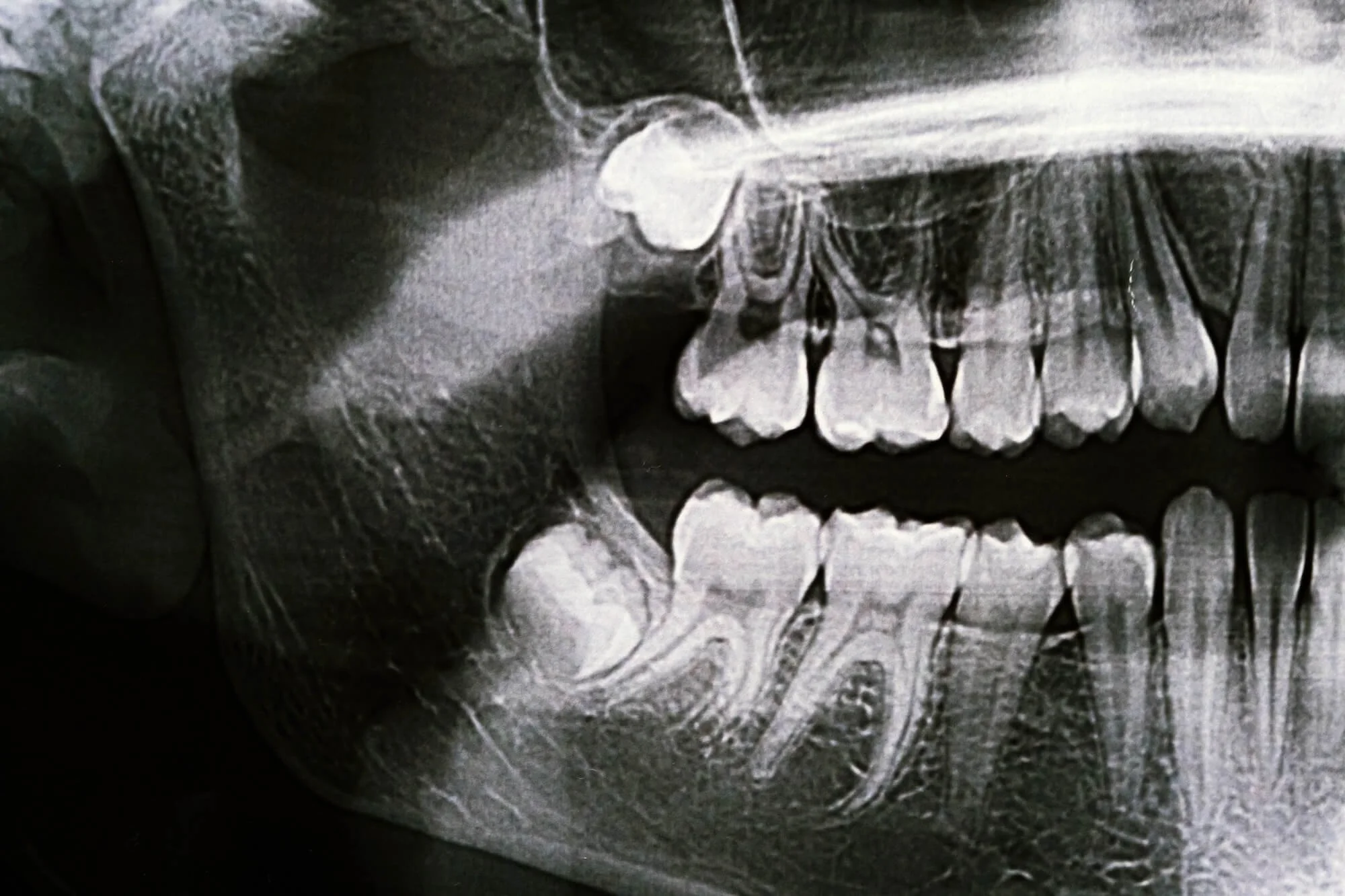 What are Wisdom Teeth