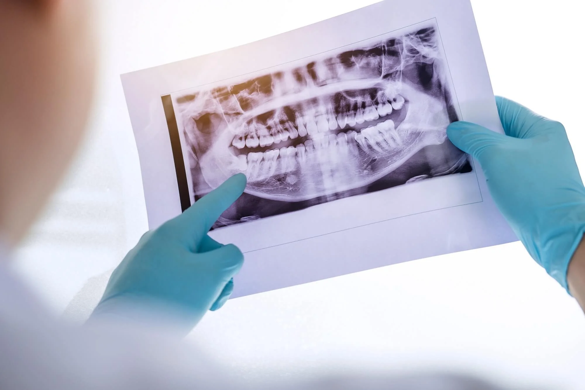 Impacted wisdom tooth