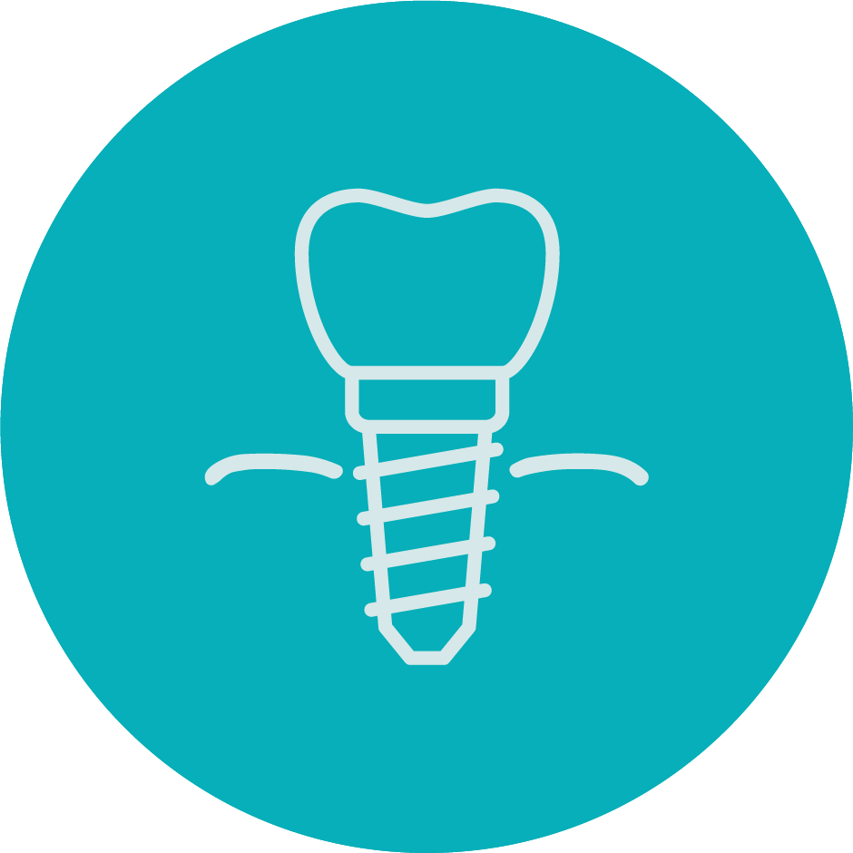 Dental Implants Graphic