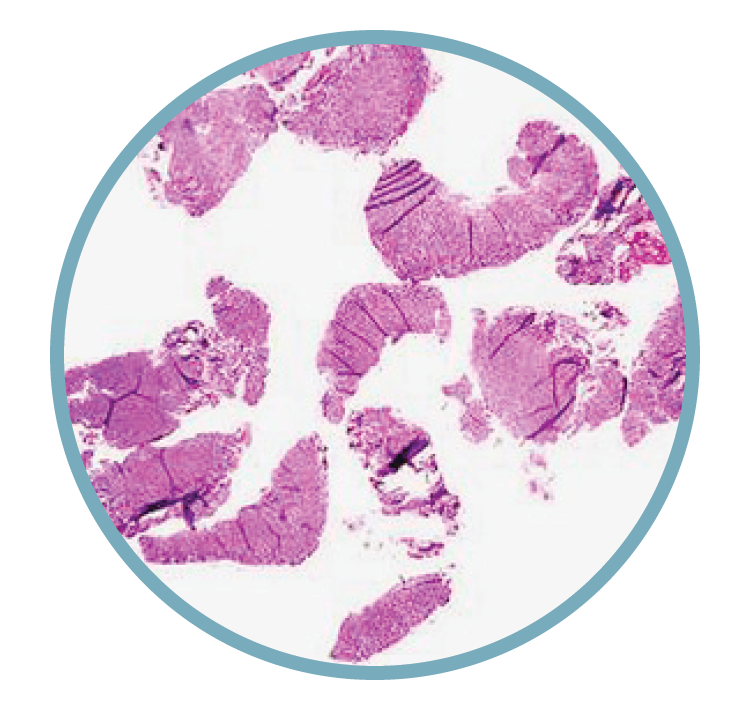 Microscopic view of biological tissue stained pink and purple, showing irregularly shaped cells and structures.