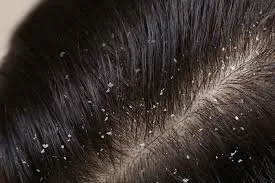 What in the World Causes Dandruff? 
