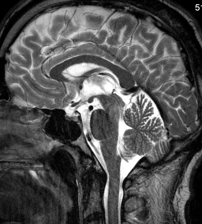 CCM is a brain disease