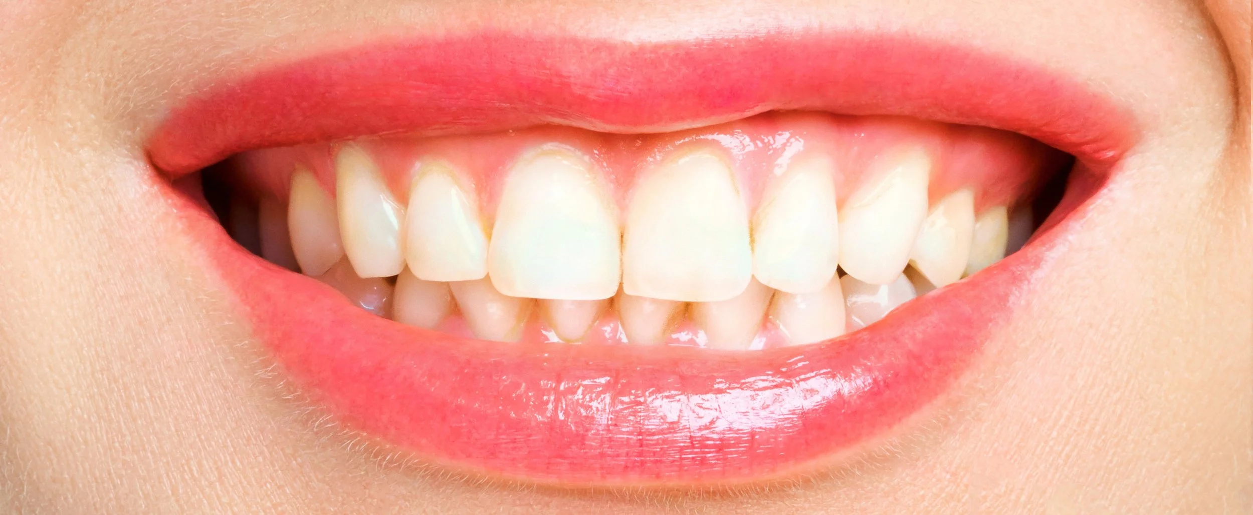 Teeth Whitening BEFORE.jpg