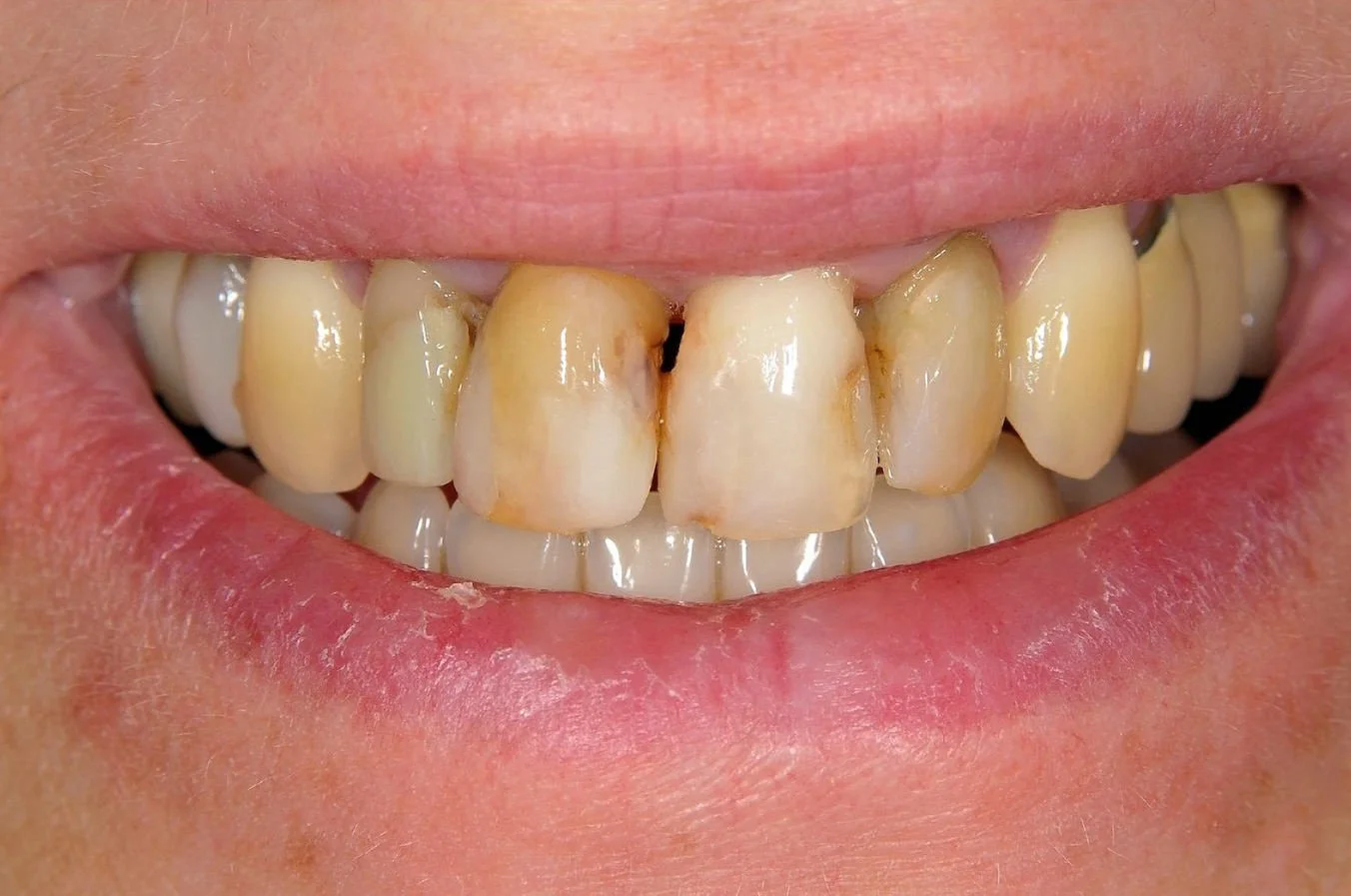 Cosmetic Veneers BEFORE.jpg