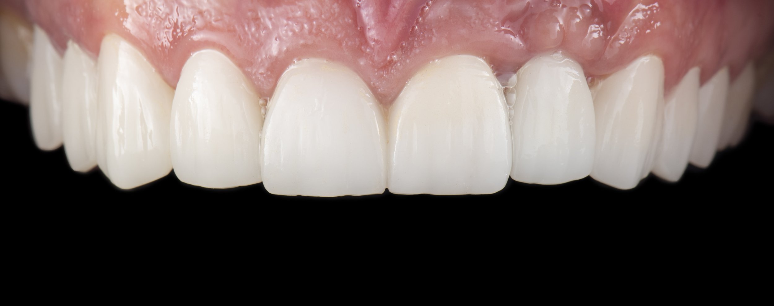 Implant:Smile Make-Over AFTER.jpg