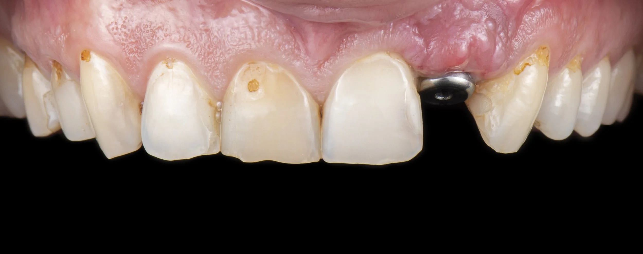 Implant:Smile Make-Over BEFORE.jpg