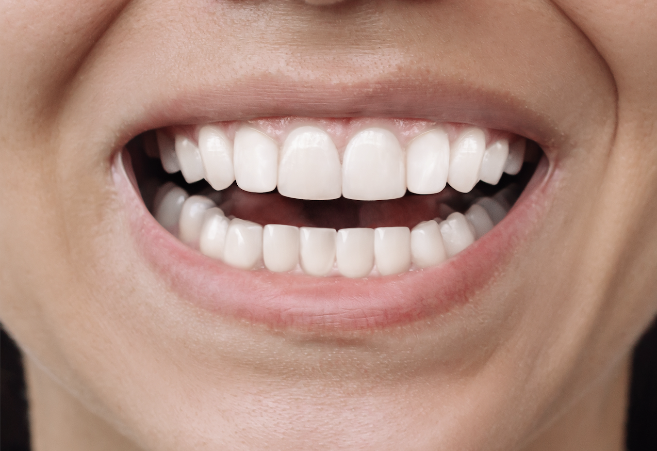 Invisalign + Whitening AFTER.png